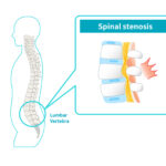 Spinal Stenosis