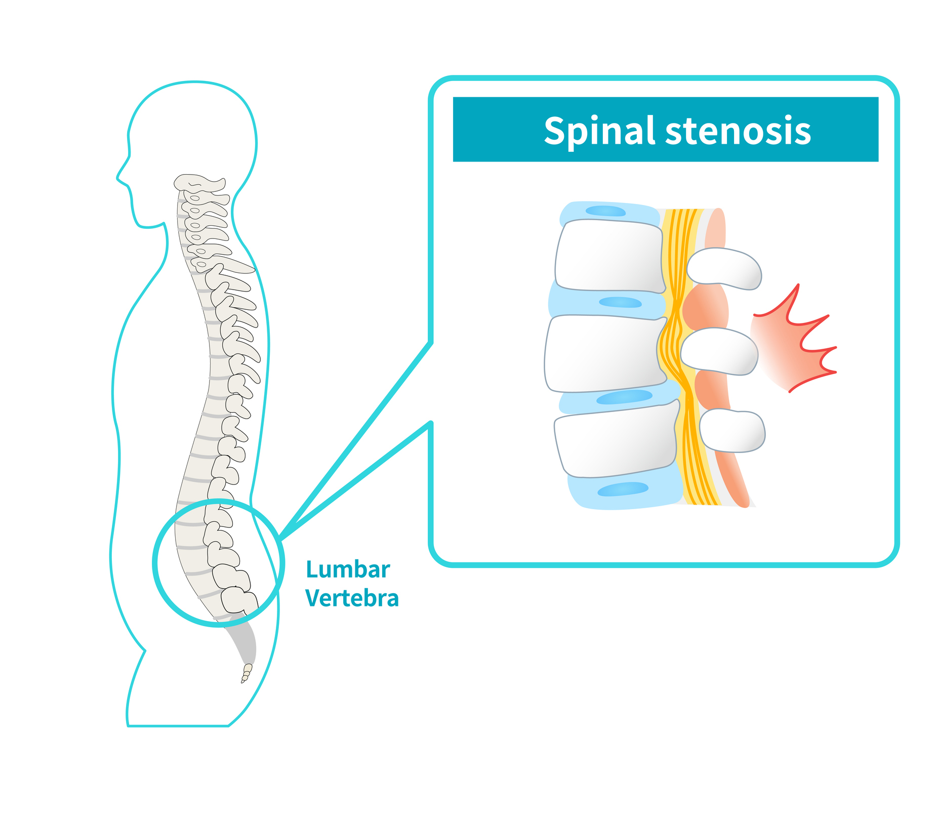 Spinal Stenosis