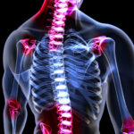 How Joint Restrictions Develop in the Spine